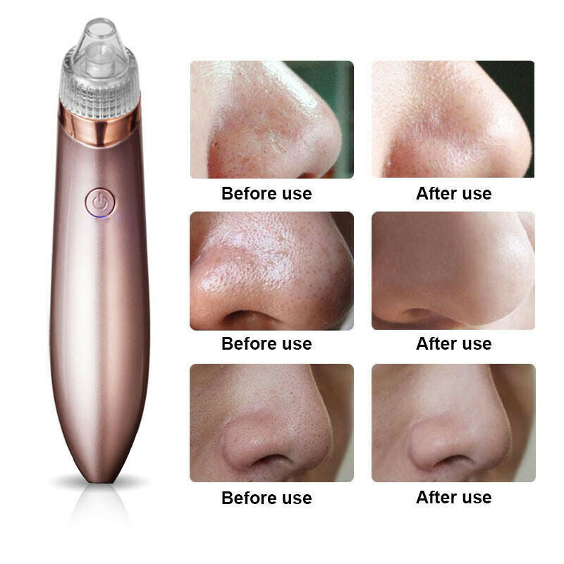 Electric Blackhead Vacuum Pore Cleaner/Remover